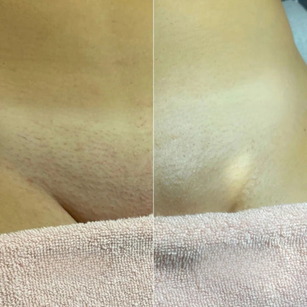 Before and After