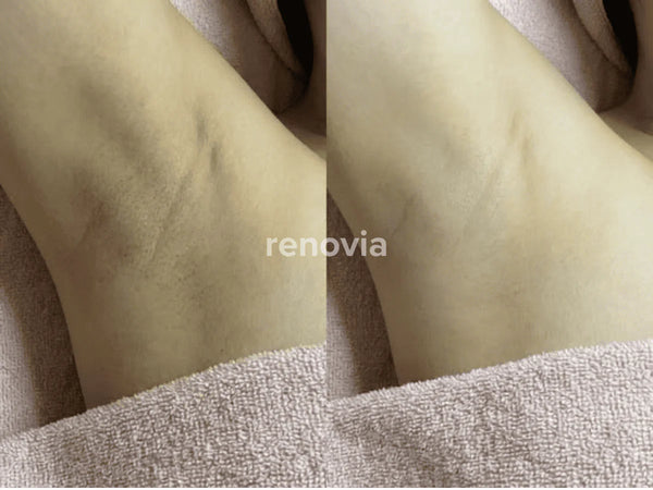 Before and After
