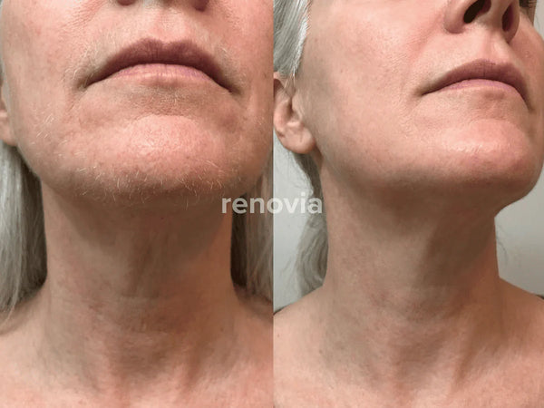 Before and After