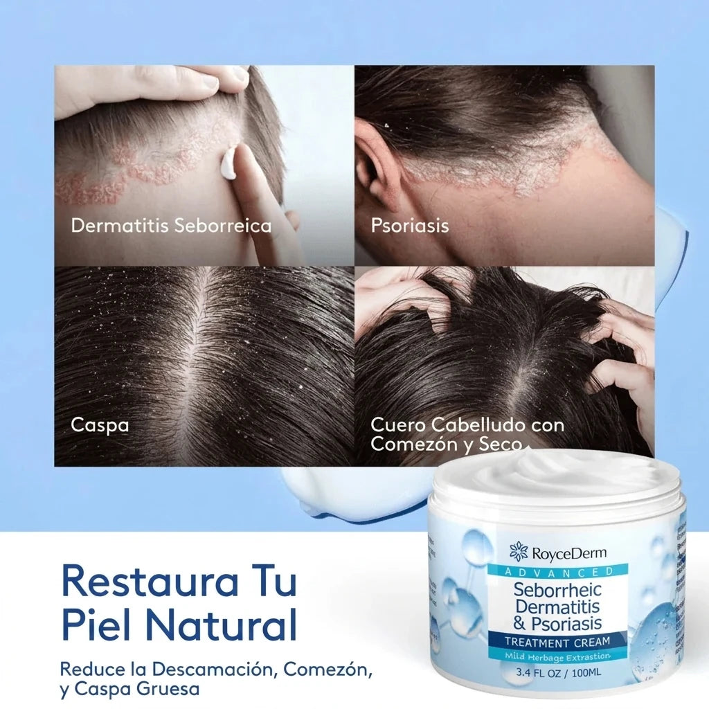 RoyceDerm – Crema para Dermatitis Seborreica y Psoriasis